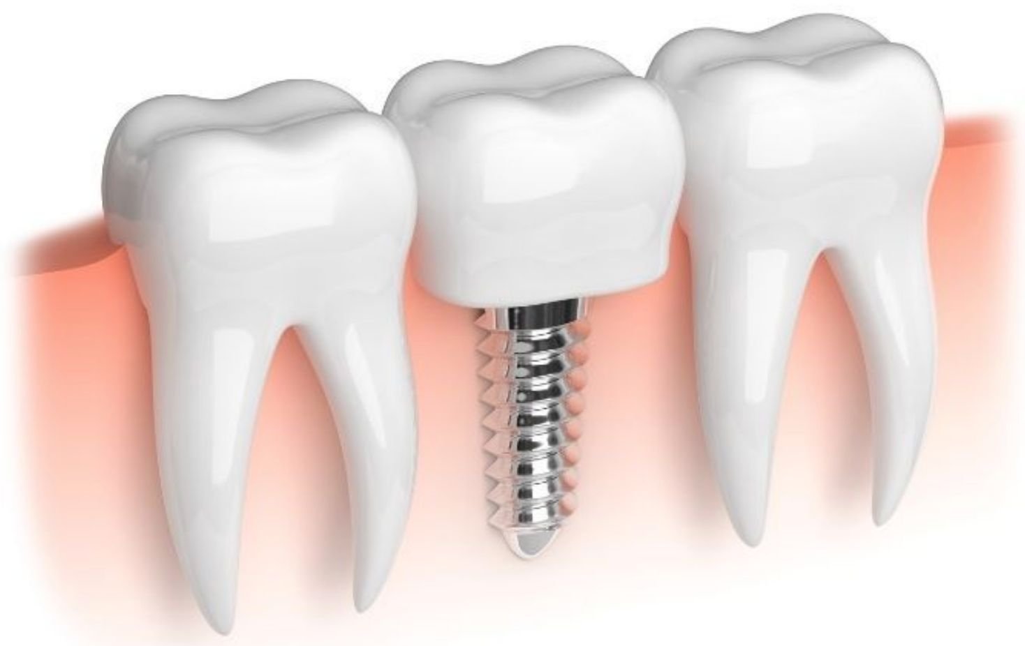 Implantes Dentales Digitales
